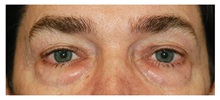 Eyelid Surgery Before Photo by Michael Law, MD; Raleigh, NC - Case 34284
