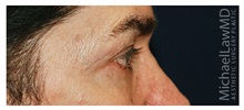 Eyelid Surgery After Photo by Michael Law, MD; Raleigh, NC - Case 34284