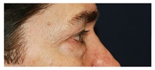 Eyelid Surgery Before Photo by Michael Law, MD; Raleigh, NC - Case 34284