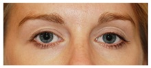 Eyelid Surgery Before Photo by Michael Law, MD; Raleigh, NC - Case 34287