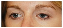 Eyelid Surgery Before Photo by Michael Law, MD; Raleigh, NC - Case 34287