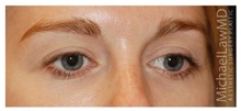 Eyelid Surgery After Photo by Michael Law, MD; Raleigh, NC - Case 34287