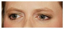 Brow Lift Before Photo by Michael Law, MD; Raleigh, NC - Case 34291