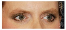 Brow Lift After Photo by Michael Law, MD; Raleigh, NC - Case 34291