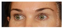 Brow Lift After Photo by Michael Law, MD; Raleigh, NC - Case 34295