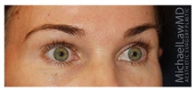Brow Lift After Photo by Michael Law, MD; Raleigh, NC - Case 34295