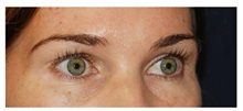 Brow Lift Before Photo by Michael Law, MD; Raleigh, NC - Case 34295