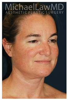 Facelift After Photo by Michael Law, MD; Raleigh, NC - Case 34969