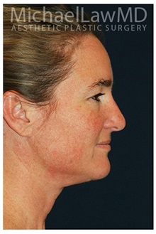 Facelift After Photo by Michael Law, MD; Raleigh, NC - Case 34969