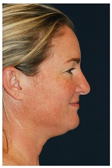Facelift Before Photo by Michael Law, MD; Raleigh, NC - Case 34969