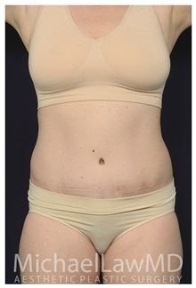 Tummy Tuck After Photo by Michael Law, MD; Raleigh, NC - Case 35212