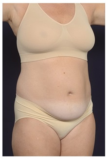 Tummy Tuck Before Photo by Michael Law, MD; Raleigh, NC - Case 35212