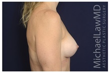 Breast Augmentation After Photo by Michael Law, MD; Raleigh, NC - Case 35213