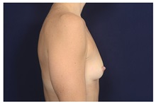 Breast Augmentation Before Photo by Michael Law, MD; Raleigh, NC - Case 35213