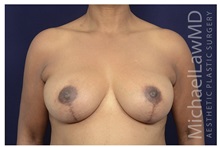 Breast Augmentation After Photo by Michael Law, MD; Raleigh, NC - Case 35214