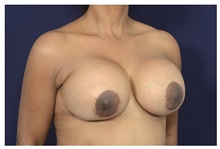 Breast Augmentation Before Photo by Michael Law, MD; Raleigh, NC - Case 35214