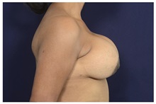 Breast Augmentation Before Photo by Michael Law, MD; Raleigh, NC - Case 35214