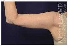 Arm Lift After Photo by Michael Law, MD; Raleigh, NC - Case 35369