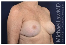 Breast Lift After Photo by Michael Law, MD; Raleigh, NC - Case 35370