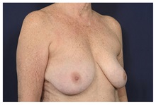 Breast Lift Before Photo by Michael Law, MD; Raleigh, NC - Case 35370