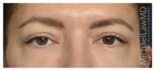 Eyelid Surgery After Photo by Michael Law, MD; Raleigh, NC - Case 35373