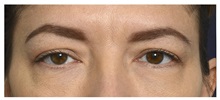 Eyelid Surgery Before Photo by Michael Law, MD; Raleigh, NC - Case 35373
