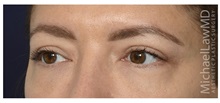 Eyelid Surgery After Photo by Michael Law, MD; Raleigh, NC - Case 35373