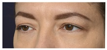 Eyelid Surgery Before Photo by Michael Law, MD; Raleigh, NC - Case 35373