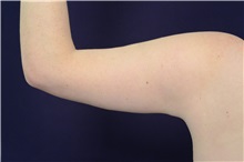 Arm Lift After Photo by Michael Law, MD; Raleigh, NC - Case 35407