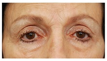 Brow Lift Before Photo by Michael Law, MD; Raleigh, NC - Case 35589