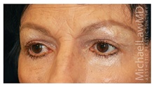 Brow Lift After Photo by Michael Law, MD; Raleigh, NC - Case 35589