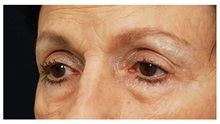 Brow Lift Before Photo by Michael Law, MD; Raleigh, NC - Case 35589