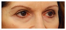 Brow Lift Before Photo by Michael Law, MD; Raleigh, NC - Case 35590