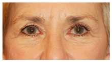 Brow Lift Before Photo by Michael Law, MD; Raleigh, NC - Case 35591
