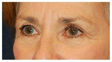 Brow Lift Before Photo by Michael Law, MD; Raleigh, NC - Case 35591