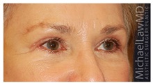 Brow Lift After Photo by Michael Law, MD; Raleigh, NC - Case 35591