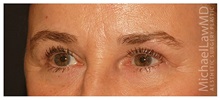 Brow Lift After Photo by Michael Law, MD; Raleigh, NC - Case 35592