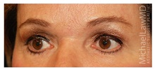 Brow Lift After Photo by Michael Law, MD; Raleigh, NC - Case 35593