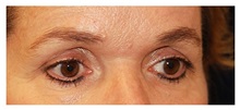 Brow Lift Before Photo by Michael Law, MD; Raleigh, NC - Case 35593