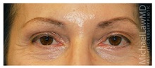 Brow Lift After Photo by Michael Law, MD; Raleigh, NC - Case 35594