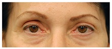 Brow Lift Before Photo by Michael Law, MD; Raleigh, NC - Case 35594