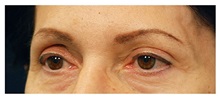Brow Lift Before Photo by Michael Law, MD; Raleigh, NC - Case 35594