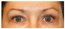 Brow Lift After Photo by Michael Law, MD; Raleigh, NC - Case 35595