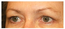 Brow Lift Before Photo by Michael Law, MD; Raleigh, NC - Case 35595