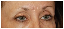 Brow Lift Before Photo by Michael Law, MD; Raleigh, NC - Case 35596