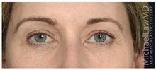 Brow Lift After Photo by Michael Law, MD; Raleigh, NC - Case 35597