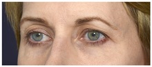 Brow Lift Before Photo by Michael Law, MD; Raleigh, NC - Case 35597