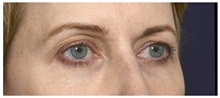 Brow Lift Before Photo by Michael Law, MD; Raleigh, NC - Case 35597