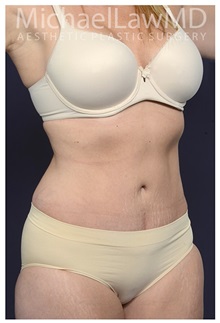 Tummy Tuck After Photo by Michael Law, MD; Raleigh, NC - Case 35598