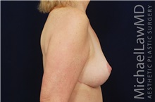 Breast Reduction After Photo by Michael Law, MD; Raleigh, NC - Case 35600